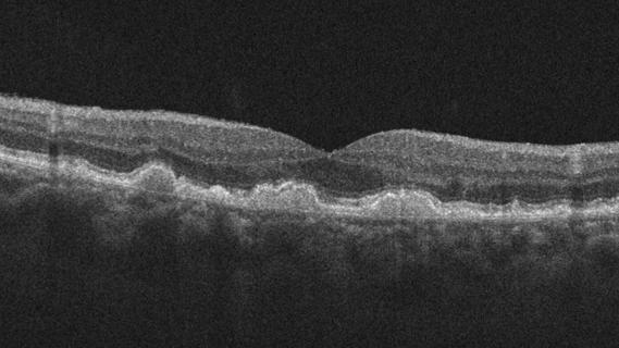 Macular degeneration
