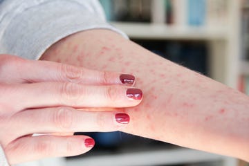 Skin rash