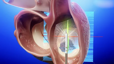High-tech heart surgery