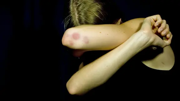Junge Frau verschränkt ihre Arme vorm Gesicht. An den Ellenbogen sind blaue Flecke.