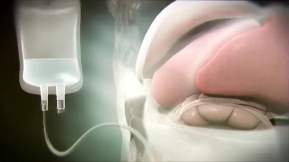Eine Animation zeigt wie eine Flüssigkeit in das Bauchfell eines Patienten geleitet wird.