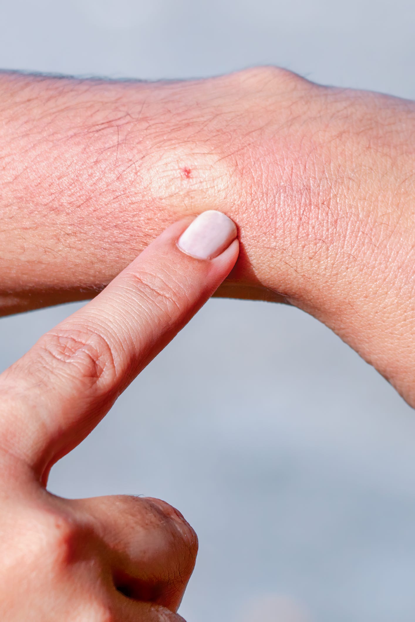 Bee sting on human skin bee sting on human skin