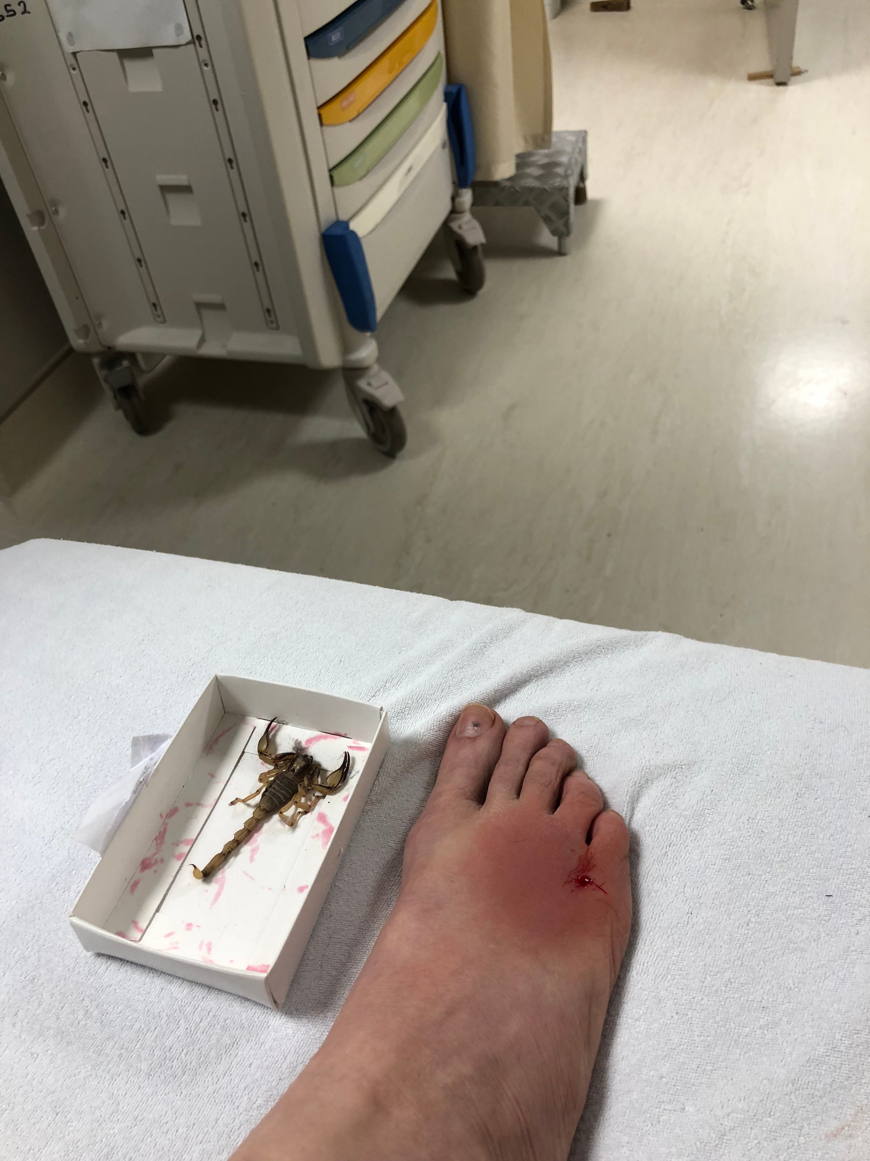 Scorpion Sting on Foot scorpion sting on foot
