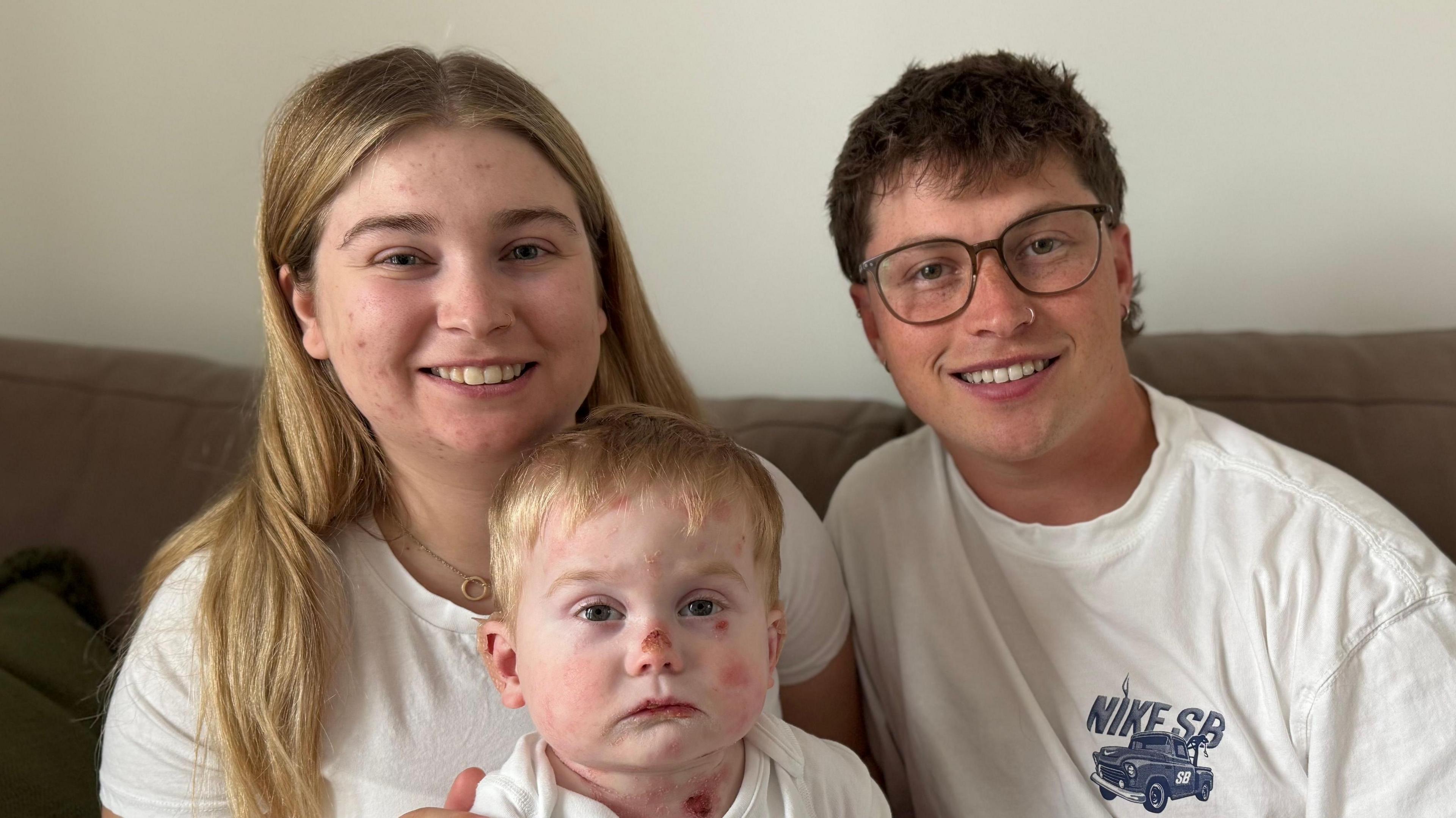 Erin and Calum with their son Albi who has blisters on his face because of his rare skin condition.