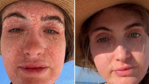 A composite image. On the left is Josie with dry, flaky skin covering her face. She is wearing a sun hat. On the right is a photo of her with clear skin, wearing the same hat.