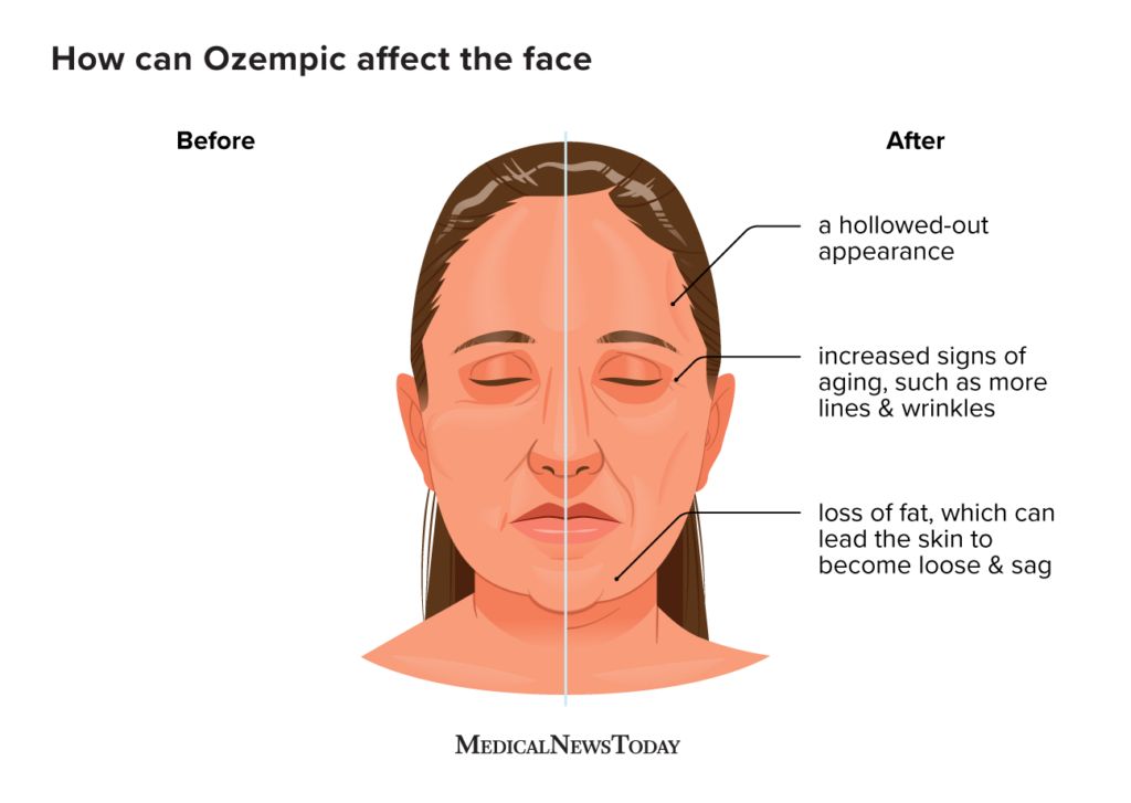 MNT Ozempic face