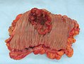 Isang masalakay na colorectal carcinoma (gitnang itaas) sa isang specimen ng colectomy.