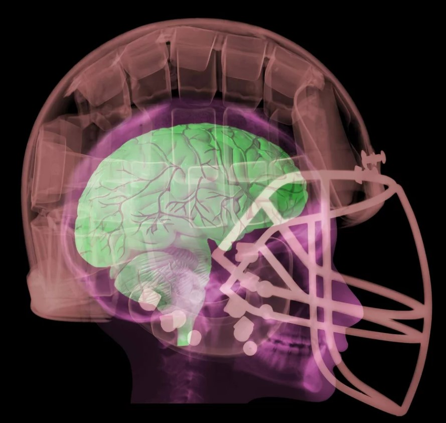 Graphic representation of an x-ray of a brain in a football helmet